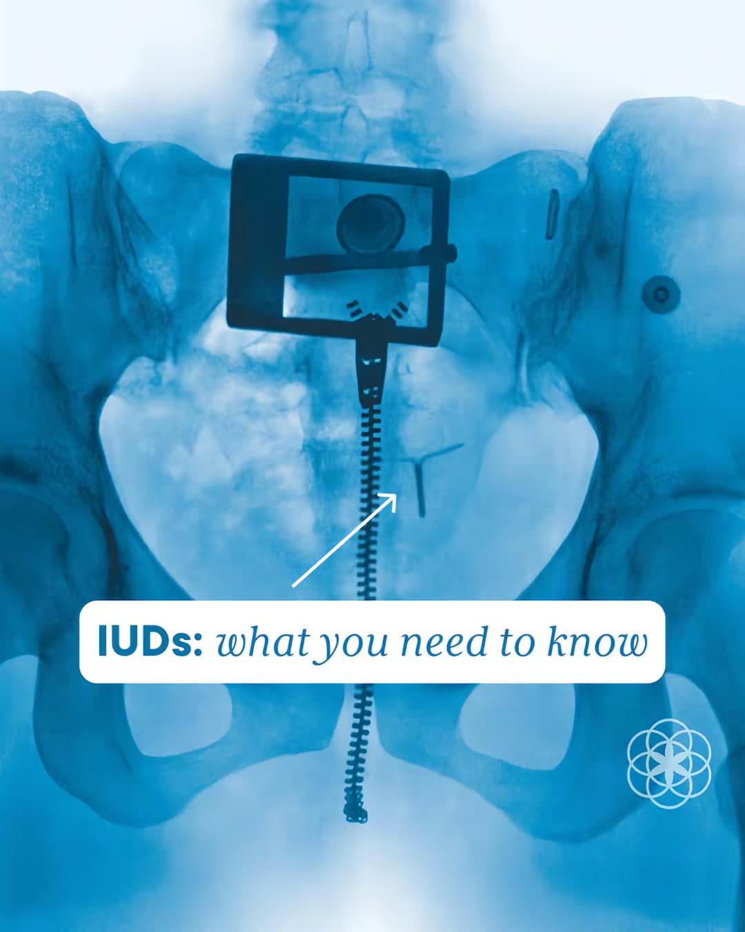 IUDs: what you need to know