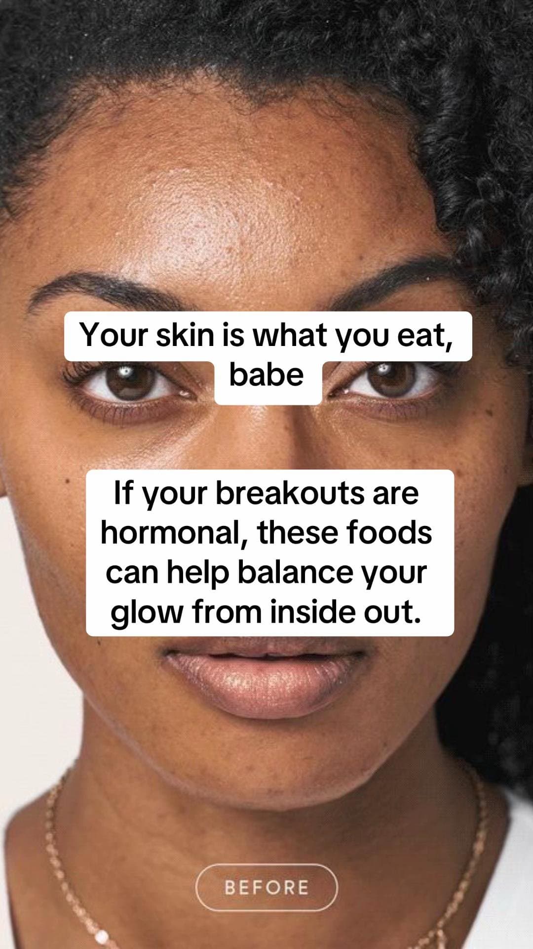 Your skin is what you eat,
babe

If your breakouts are
hormonal, these foods
can…