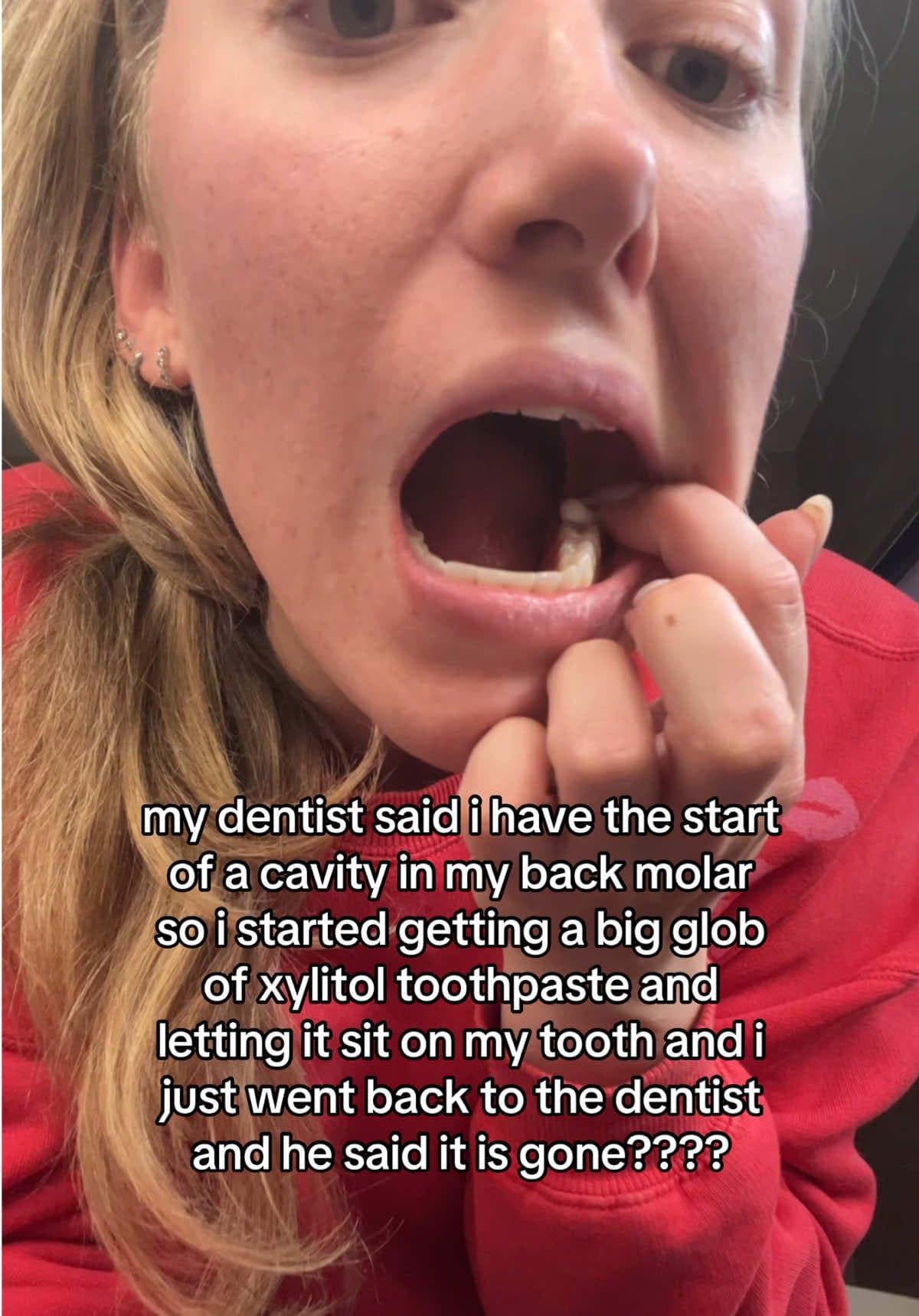 my dentist said i have the start
of a cavity in my back molar
so i started getti…