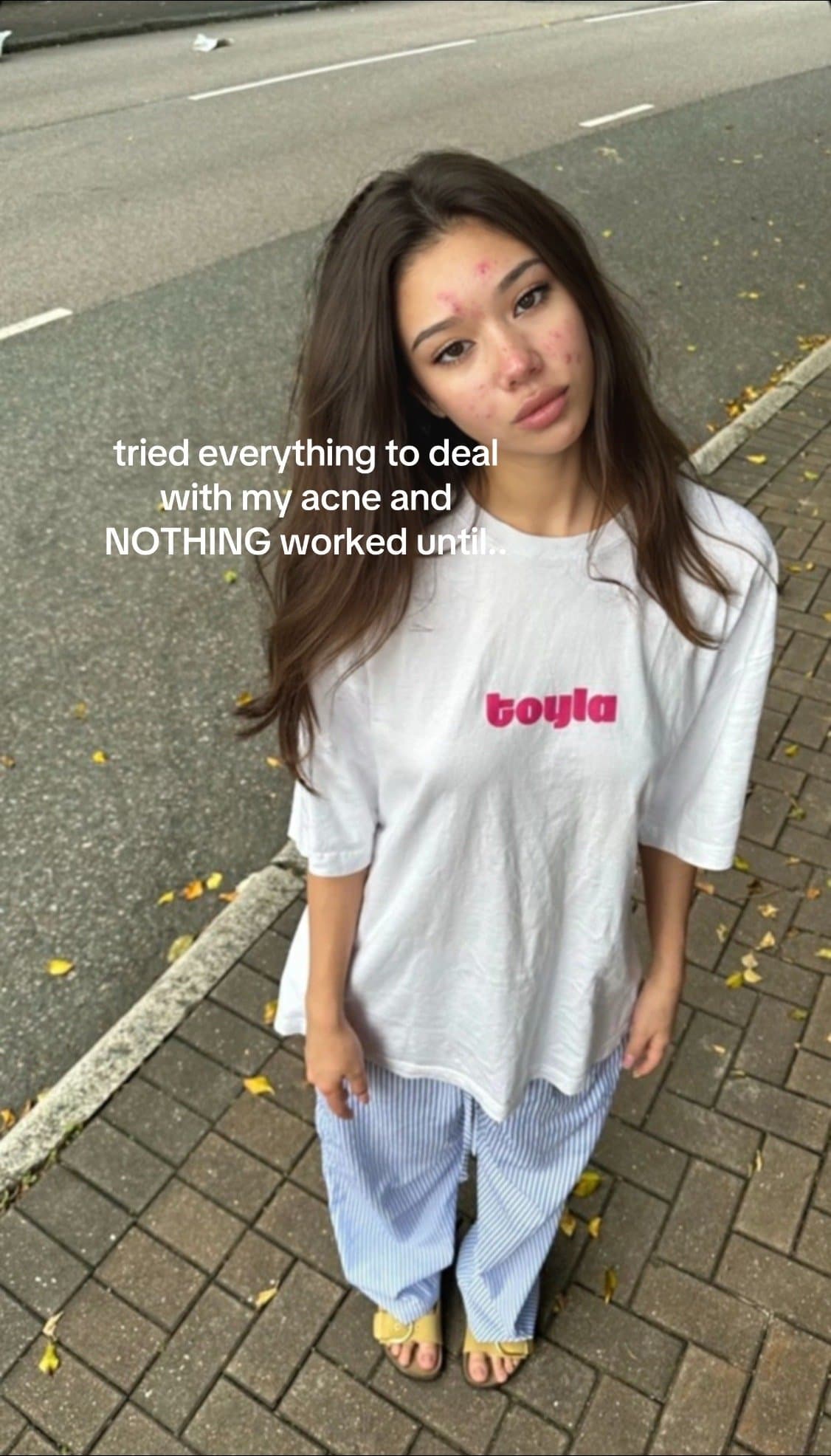 tried everything to deal
with my acne and
NOTHING worked until...